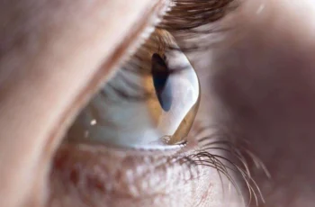Seeing Clearly Again: Understanding Keratoconus and Advanced Treatments