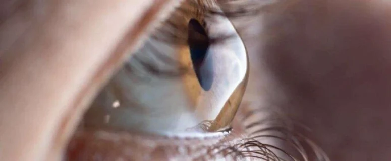 Seeing Clearly Again: Understanding Keratoconus and Advanced Treatments Seeing Clearly Again: Understanding Keratoconus and Advanced Treatments